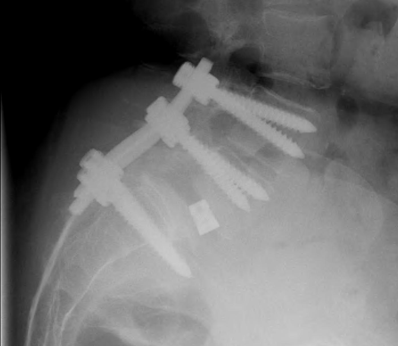 Spondylolithesis PLIF